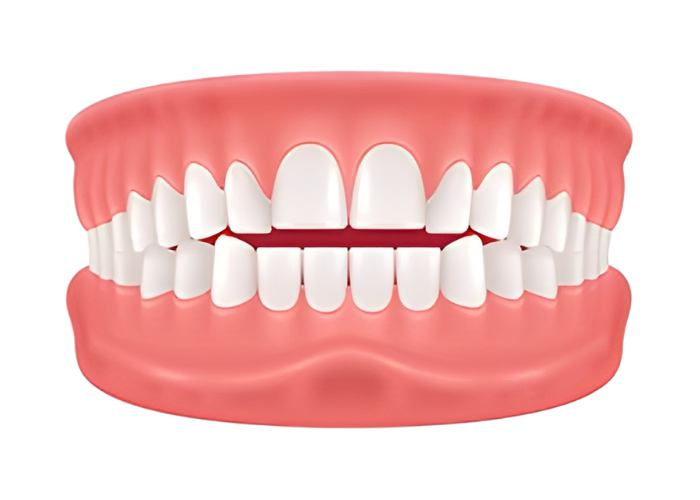 Açık Kapanış — Open Bite