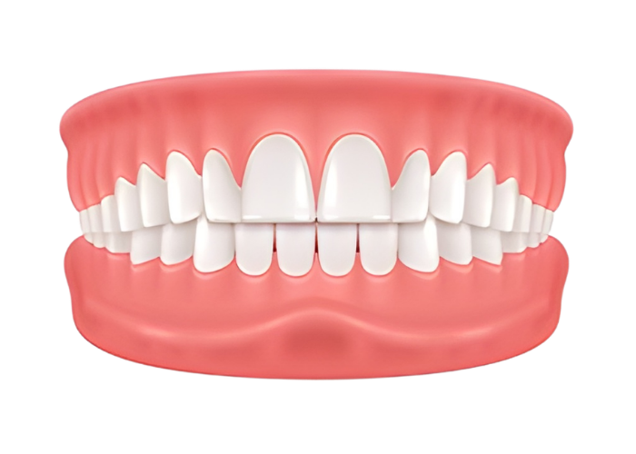 Angle Class II — Üst çene önde